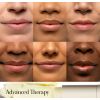 Sugar Advanced Therapy Lip BalmSugar Advanced Therapy Treatment Lip Balm